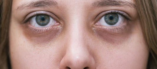 How To Get Rid Of Dark Circles Naturally?