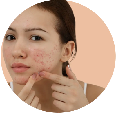 Acne Skin