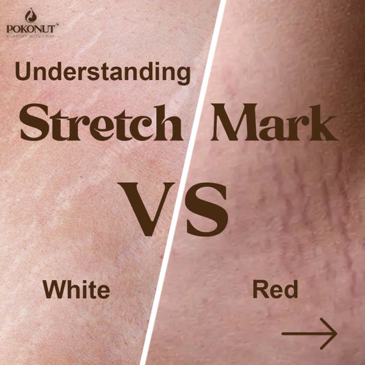 Stretch Marks 101: Prevention, Treatment, and Care