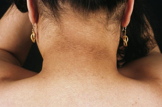 Understanding Dark Patches: Causes and Solutions