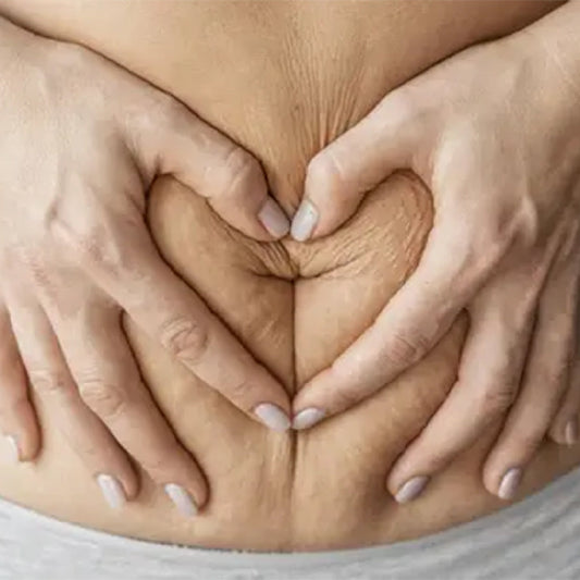 Goodbye to Stretch Marks: The Ultimate Guide to Choosing the Best Ayurvedic Cream