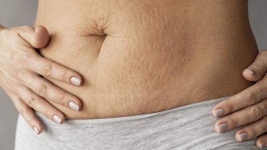All About Stretch Marks: Answers to Your Questions