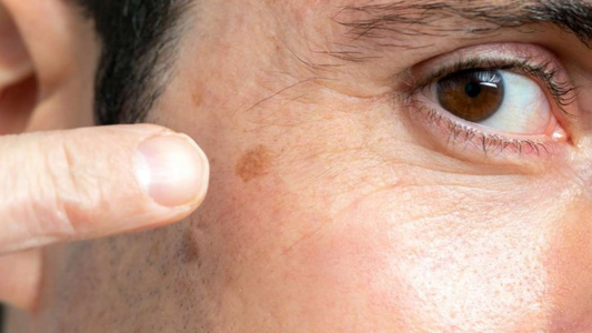 How To Remove Hyperpigmentation Around Mouth?