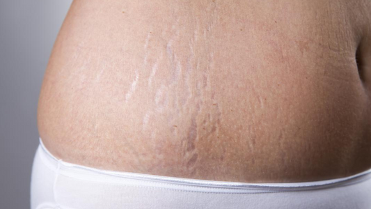 What is the fastest way to fade stretch marks?