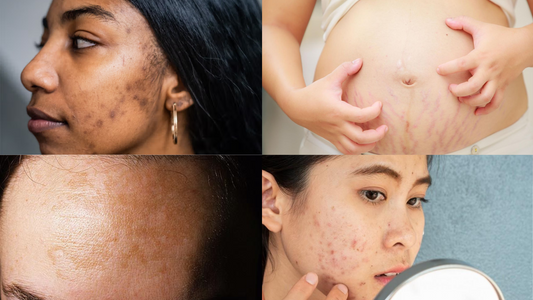 Natural Remedies for Common Skin Issues During Pregnancy
