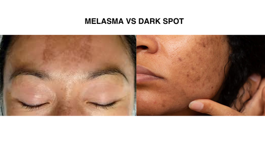 Dark Spots vs. Melasma: How To Tell The Difference And Treat Them