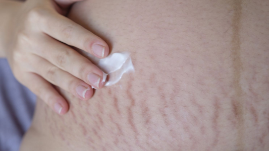 Is There A Way To Avoid Stretch Marks During Pregnancy?