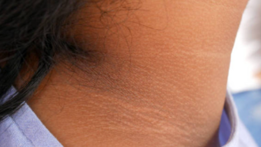 How to Get Rid of A Black Neck Overnight?