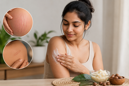 Does Shea Butter Help Reduce Stretch Marks and Scars