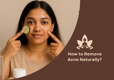 Simple Skincare Tips to Get Rid of Acne Naturally