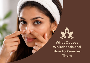 What are Whiteheads