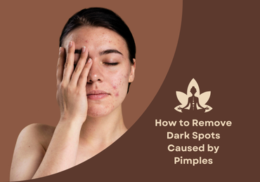 How to Remove Dark Spots Caused by Pimples: Remedies, Ingredients & Product Tips