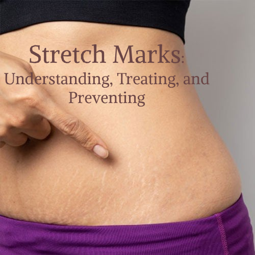 "Stretch Marks: Understanding, Treating, and Preventing"