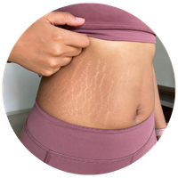 Stretch Marks