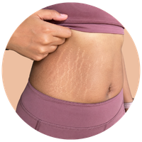 Stretch Marks
