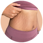 Stretch Marks