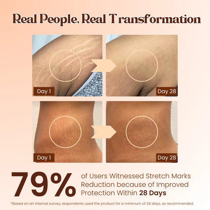 Stretch Mark Repair Combo – Day and Night Care for Visible Results