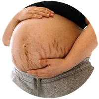 Stretch Marks