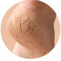 Foot Cracks