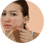 Acne Skin