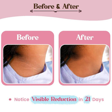 Dark Patch Reducer Cream- 50gm